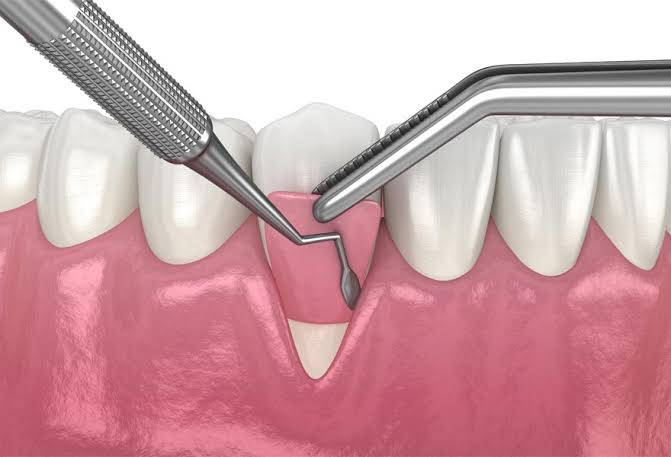 Gum Surgery vs. Non-Surgical Gum Treatment: What’s the Difference? Gum Surgery vs. Non-Surgical Gum Treatment: What’s the Difference?