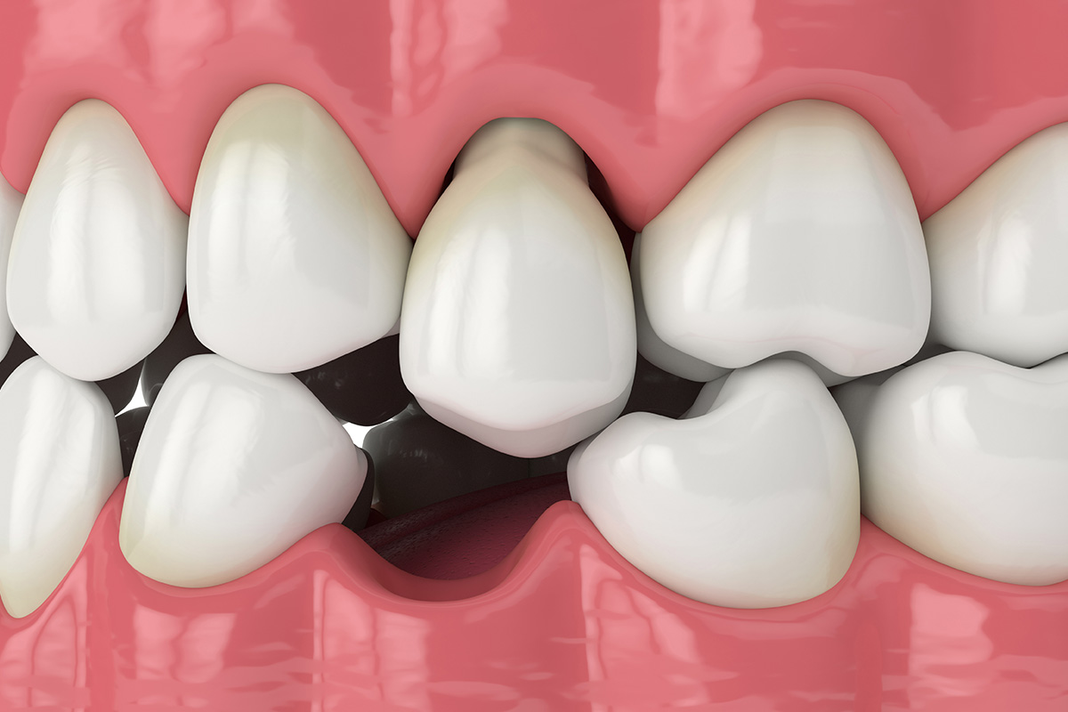Are Dental Implants a Suitable Option for Missing Teeth? Are Dental Implants a Suitable Option for Missing Teeth?